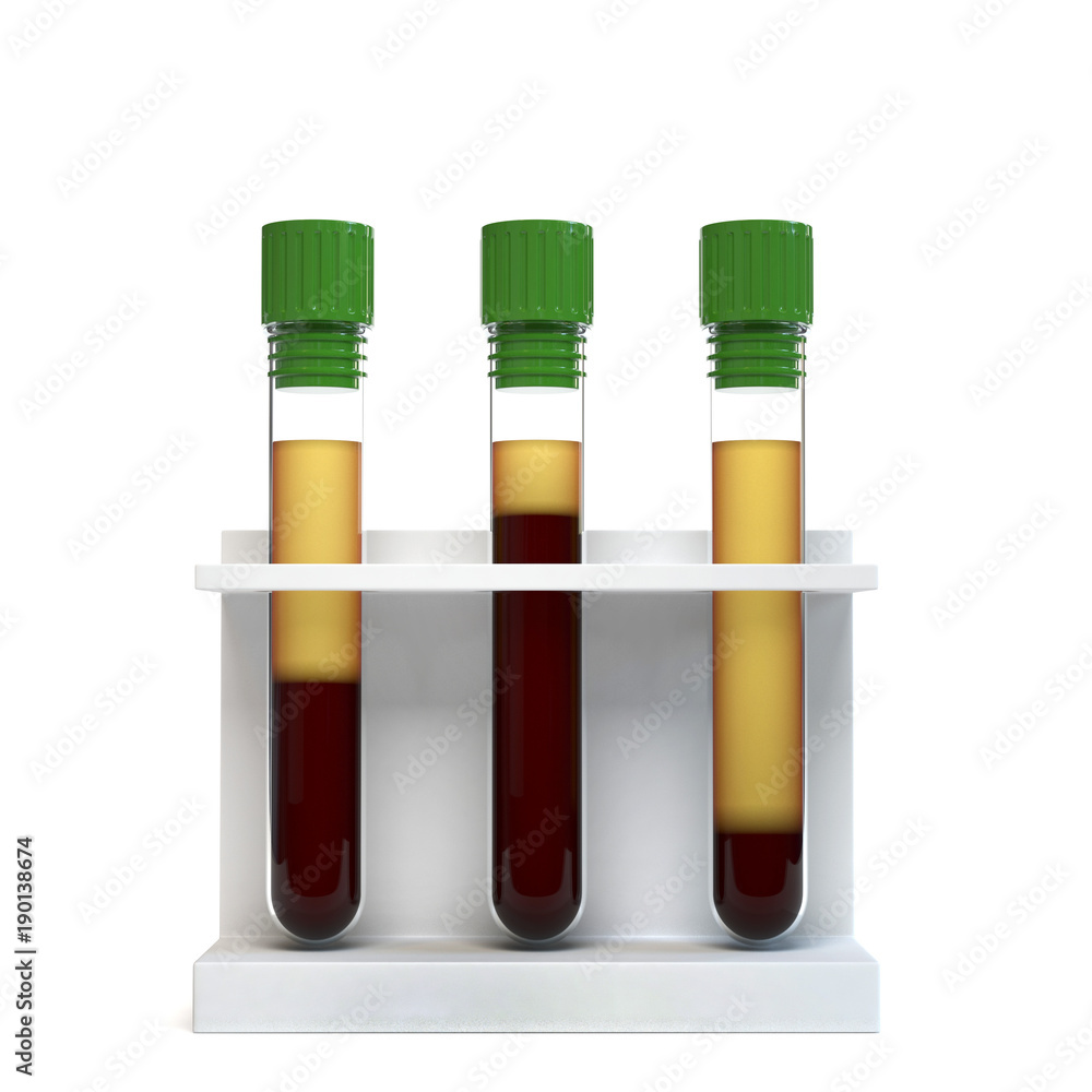 Blood centrifugations show normal and abnormal level of red blood cells. Hematocrit test concept. Blood centrifugations show normal and abnormal level of red blood cells. Hematocrit test concept.