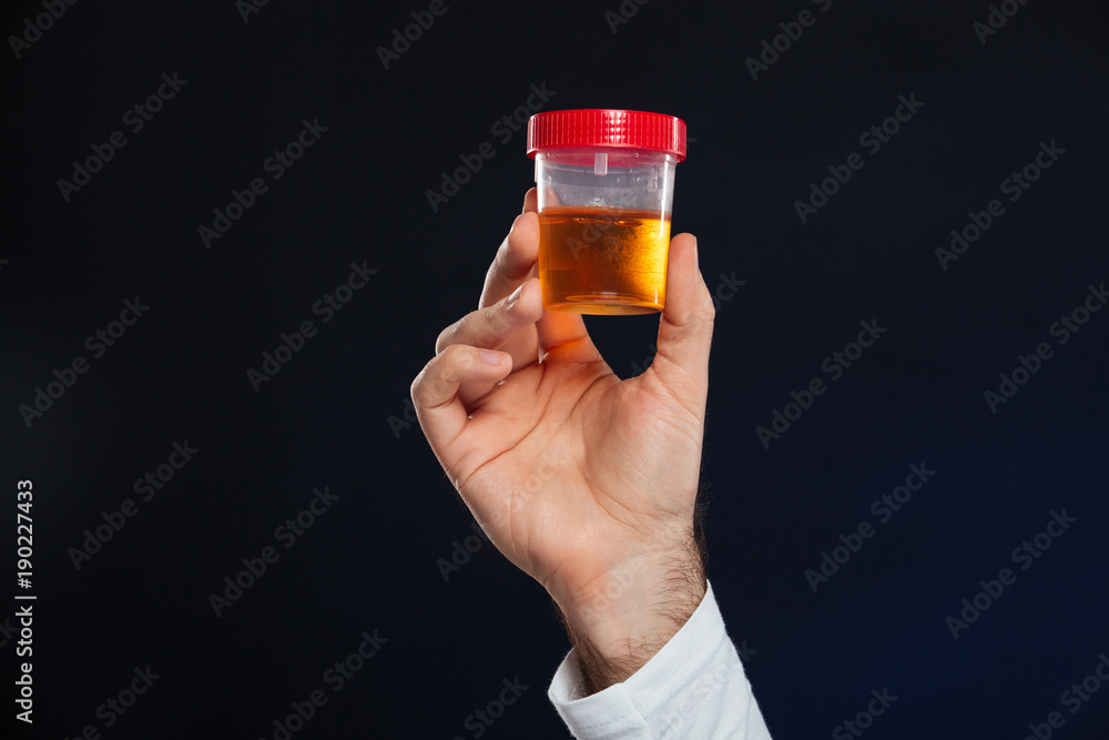 Close up of male's hand holding container with urine sample Close up of male's hand holding container with urine sample