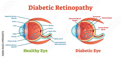 Diabetic Retinopathy vector illustration diagram, anatomical scheme.  photo