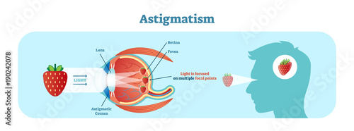 Astigmatism vector illustration diagram, anatomical scheme. 