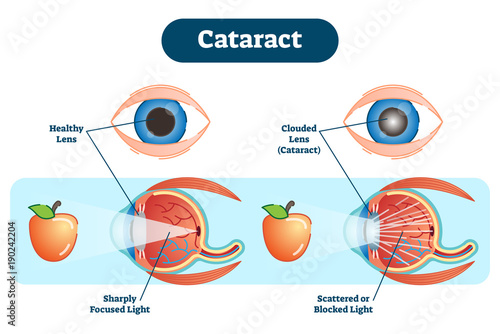 Cataract vector illustration diagram, anatomical scheme. 