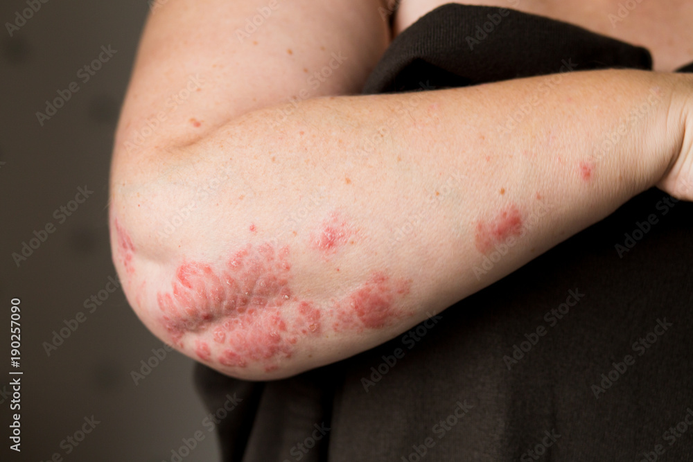The problem with many people - eczema on hand. Dark background. Man itchind skin. The problem with many people - eczema on hand. Dark background. Man itchind skin.