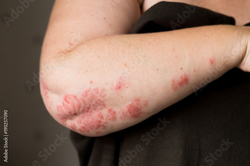 The problem with many people - eczema on hand. Dark background. Man itchind skin.