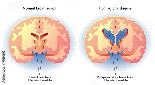 vector medical illustration of the symptoms of Huntington's disease