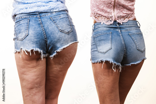 Comparison of legs with and without cellulite