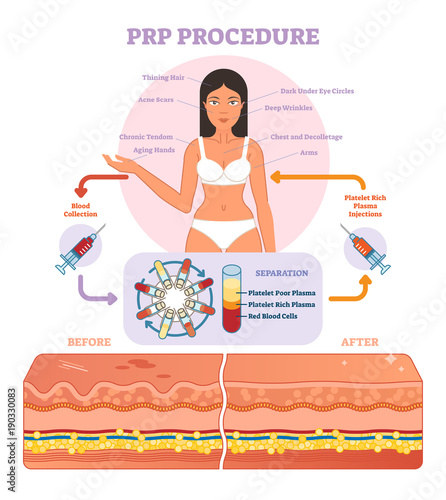 PRP Procedure vector illustration graphic diagram, cosmetology procedure scheme. 