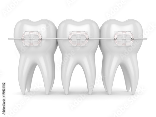 3d render of teeth with ceramic clear braces