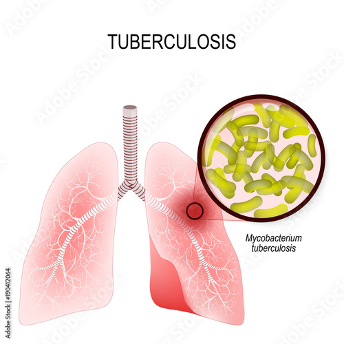 Tuberculosis is an infection caused by bacteria. Lungs of infected person