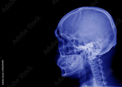 X-ray image of side view asian skull black and white