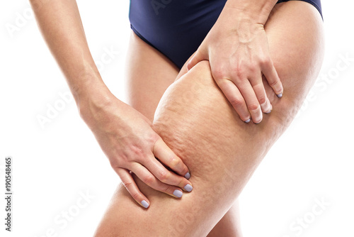 Obraz na płótnie Cellulite on female legs.