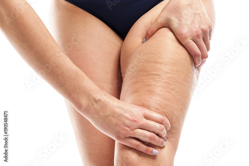 Cellulite on female legs. photo