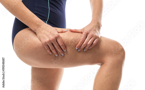 Cellulite on female legs.