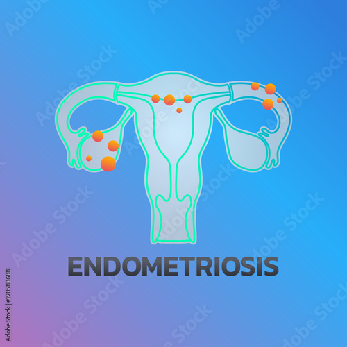 Endometriosis icon design, infographic health. Vector illustration.
