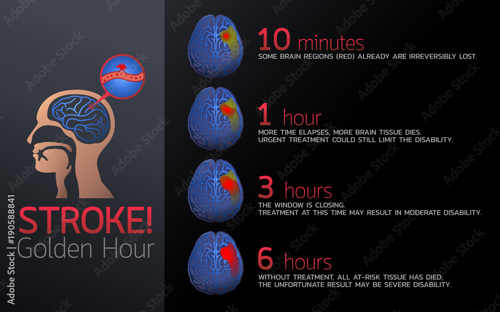 Stroke Golden Hour Icon Design Infographic Health Medical Infographic the-golden-team-legend-of-hungarian-football-hungarianhub