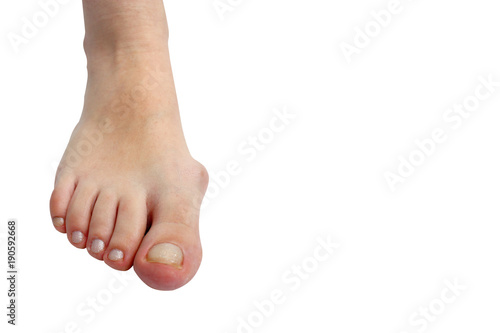 Medecin, valgus bunion, leg with deformation valgus hallux (Bunion), consequence of failure of treatment, isolated on white background with clipping path, place for text © игорь перекрестоd