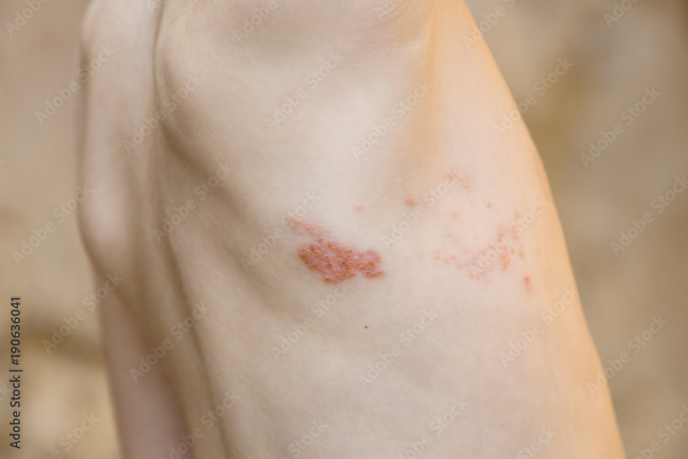 Symptom of herpes zoster (shingles)