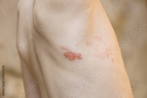 Symptom of herpes zoster (shingles) photo