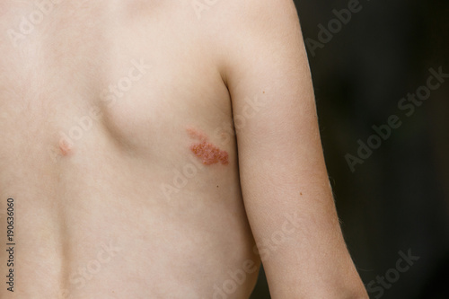 Symptom of herpes zoster (shingles) photo