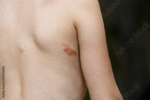 Obraz na płótnie Symptom of herpes zoster (shingles) w salonie