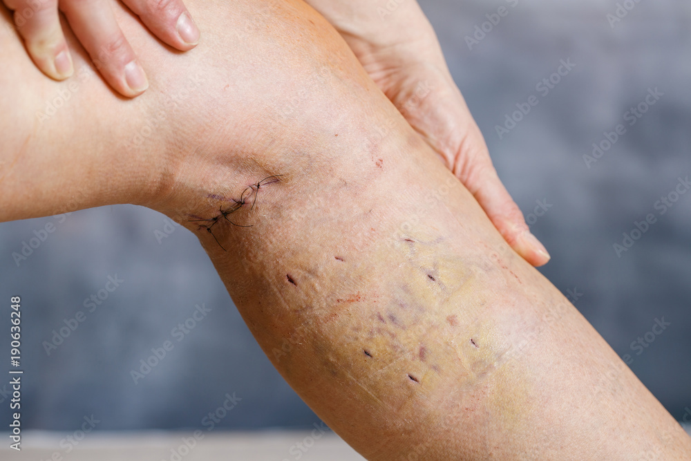 Womans leg after phlebectomy