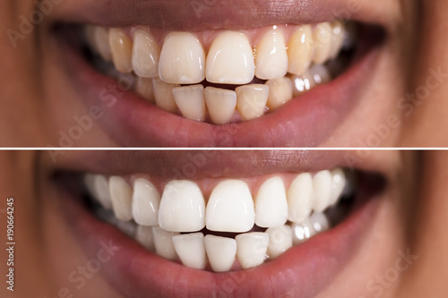 Woman Teeth Before And After Whitening photo