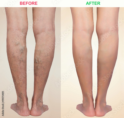 Canvas Print Treatment of varicose before and after