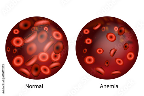 Iron deficiency anemia.The difference of Anemia amount of red blood cell and normal.  photo