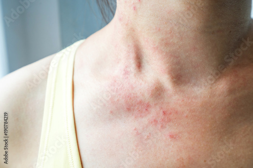 Young woman has skin rash itch on neck photo