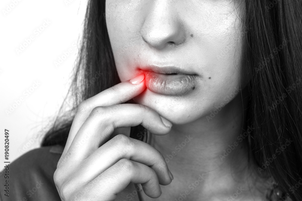 Close up portrait of a pretty woman beautiful lips infected herpes virus. Black and white with a red accent Close up portrait of a pretty woman beautiful lips infected herpes virus. Black and white with a red accent