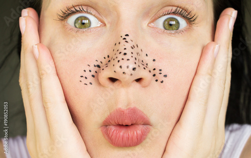 Εκτύπωση καμβά girl with problem skin. pimples on the face