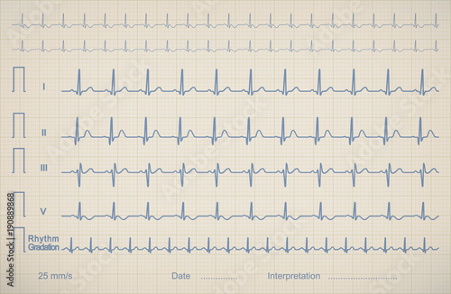 ECG chart image of medical patient, vector illustration.