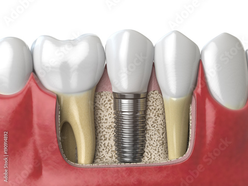 Fototapeta Naklejka Na Ścianę i Meble -  Anatomy of healthy teeth and tooth dental implant in human dentura.
