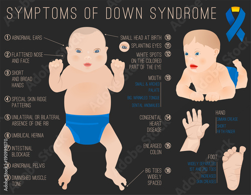 Down Syndrom Symptoms