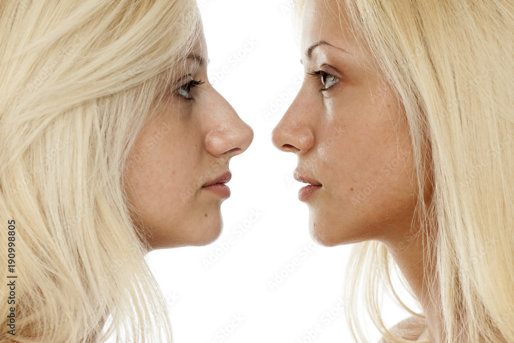 comparison of nose surgery, befora and after comparison of nose surgery, befora and after