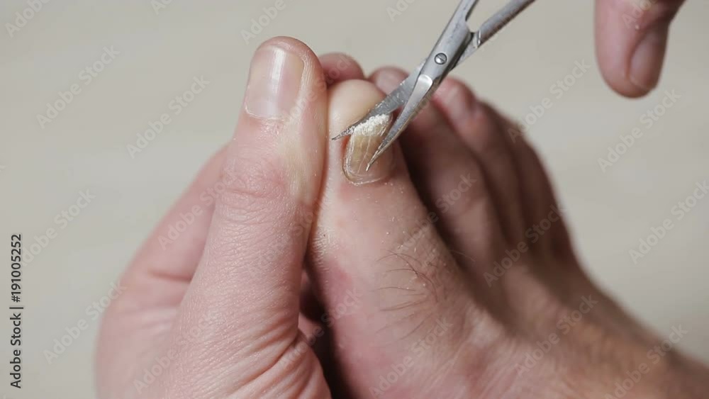 Man cutting toenails with scissors. Male cut toenails on foot. Toenails with fungal infection