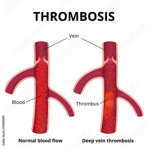 thrombus formation