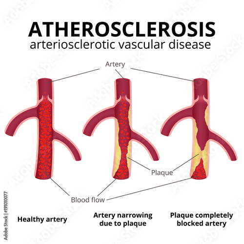 coronary artery disease