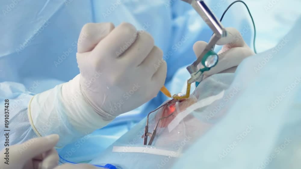 A close-up of assistants hands using a syringe during an eye operation. A close-up of assistants hands using a syringe during an eye operation.