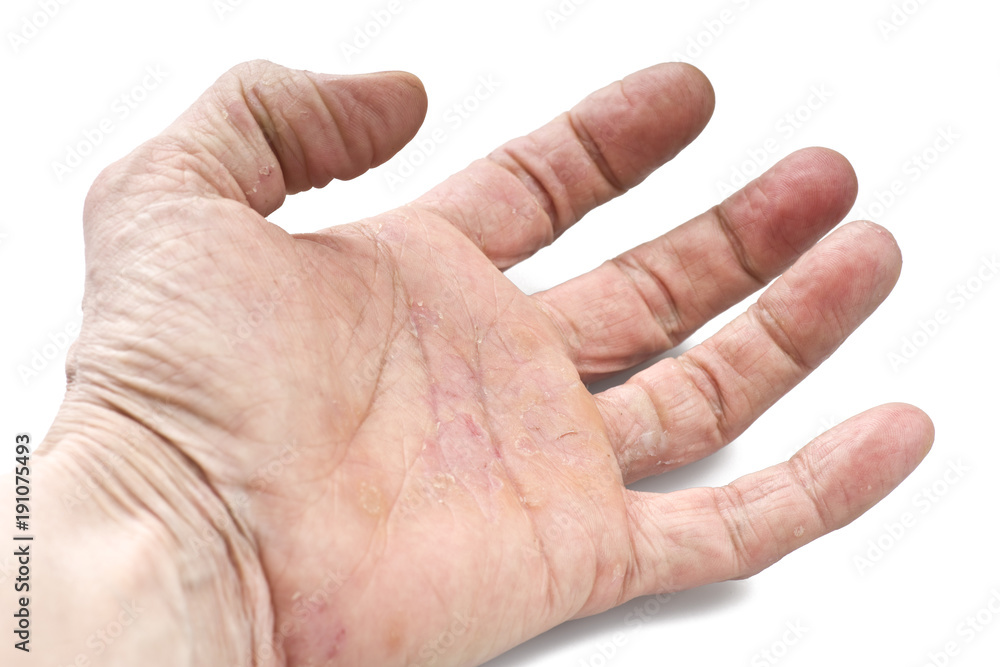 Psoriasis, skin disease on the joints of the body Psoriasis, skin disease on the joints of the body