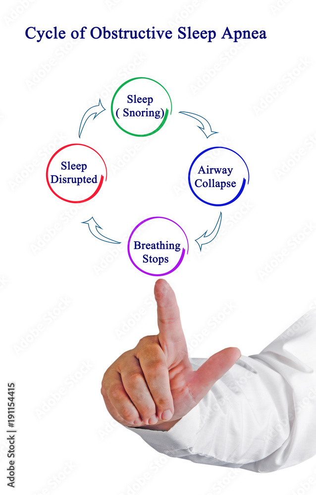 Cycle of Obstructive Sleep Apnea Cycle of Obstructive Sleep Apnea