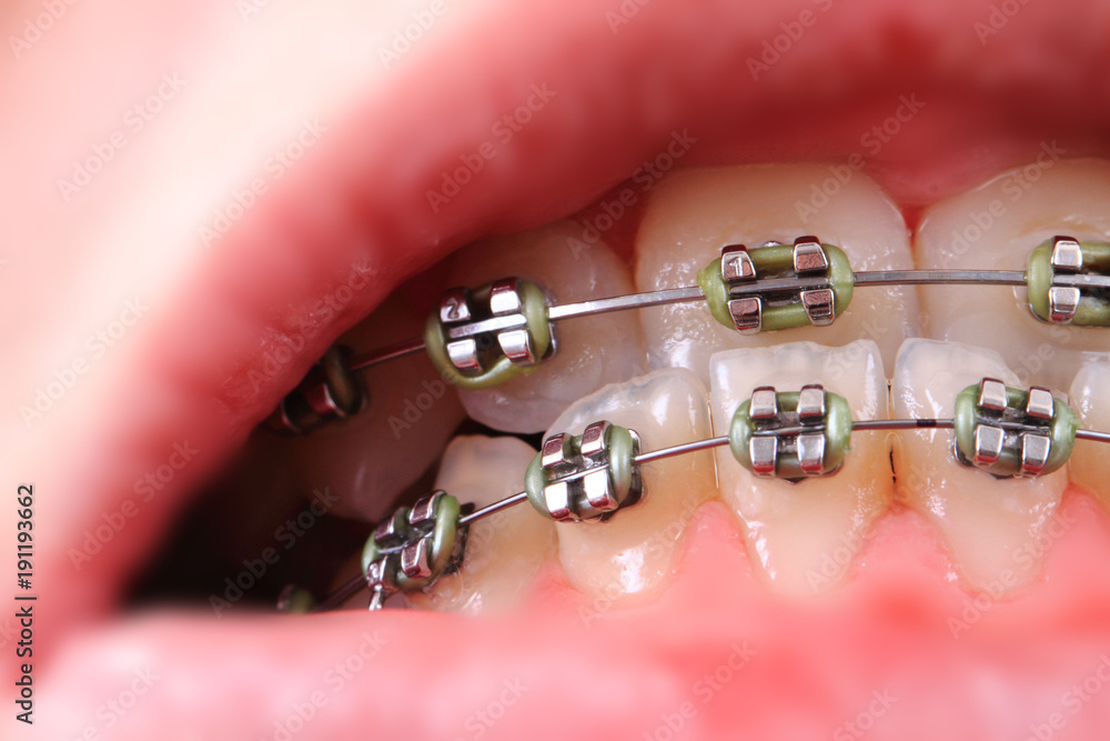 Fototapeta premium braces in the young mouth