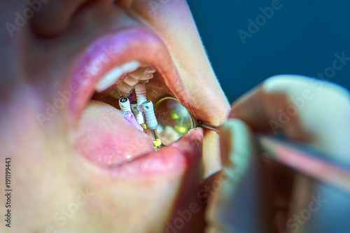 Dental files stick out in the patient's tooth. Medical examination.