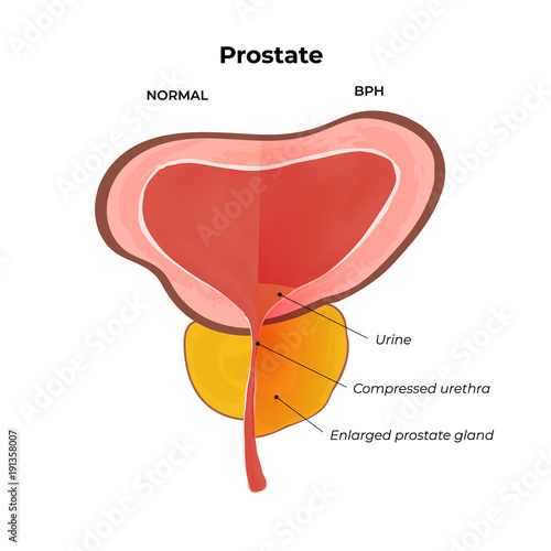 BPH infographics. Prostatic hyperplasia. Normal and inflamed prostate gland