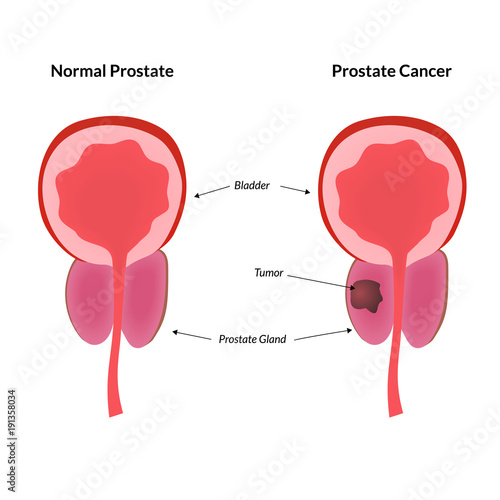 Tumor in prostate gland is a common cancer harbinger