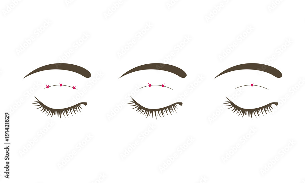 二重手術のイラスト素材 Stock Vector Adobe Stock 二重手術のイラスト素材 Stock Vector Adobe Stock