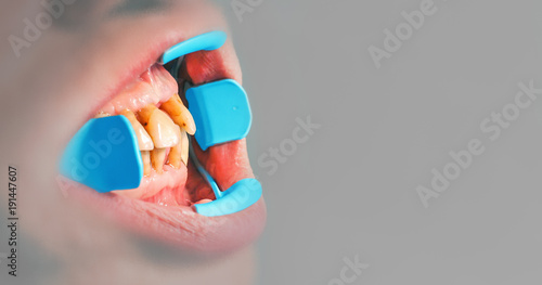 Gums and tooth structure have been worn away leading to exposed root surface and sensitivity