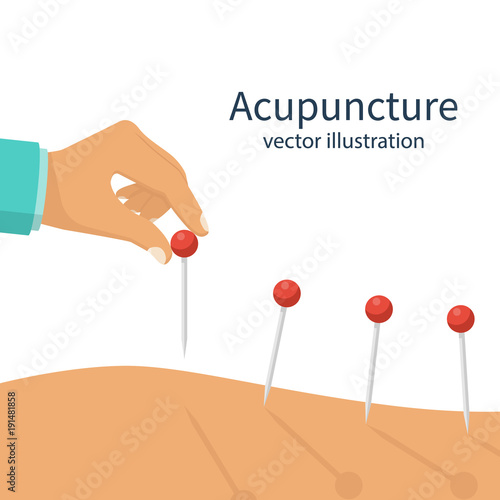 Acupuncture treatment closeup. Salon spa center. Needle in hand. Prick patient's body. Vector illustration flat design. Isolated on white background. Alternative medicine. Healthcare concept.