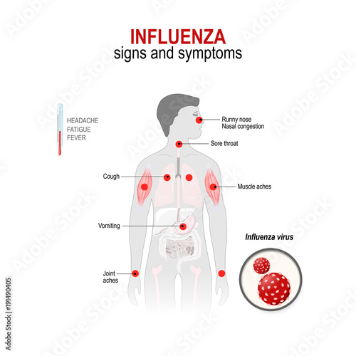 Influenza. Signs and symptoms