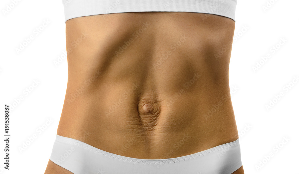 Diastasis recti. Woman's abdomen divergence of the muscles of the abdomen after pregnancy and childbirth.
