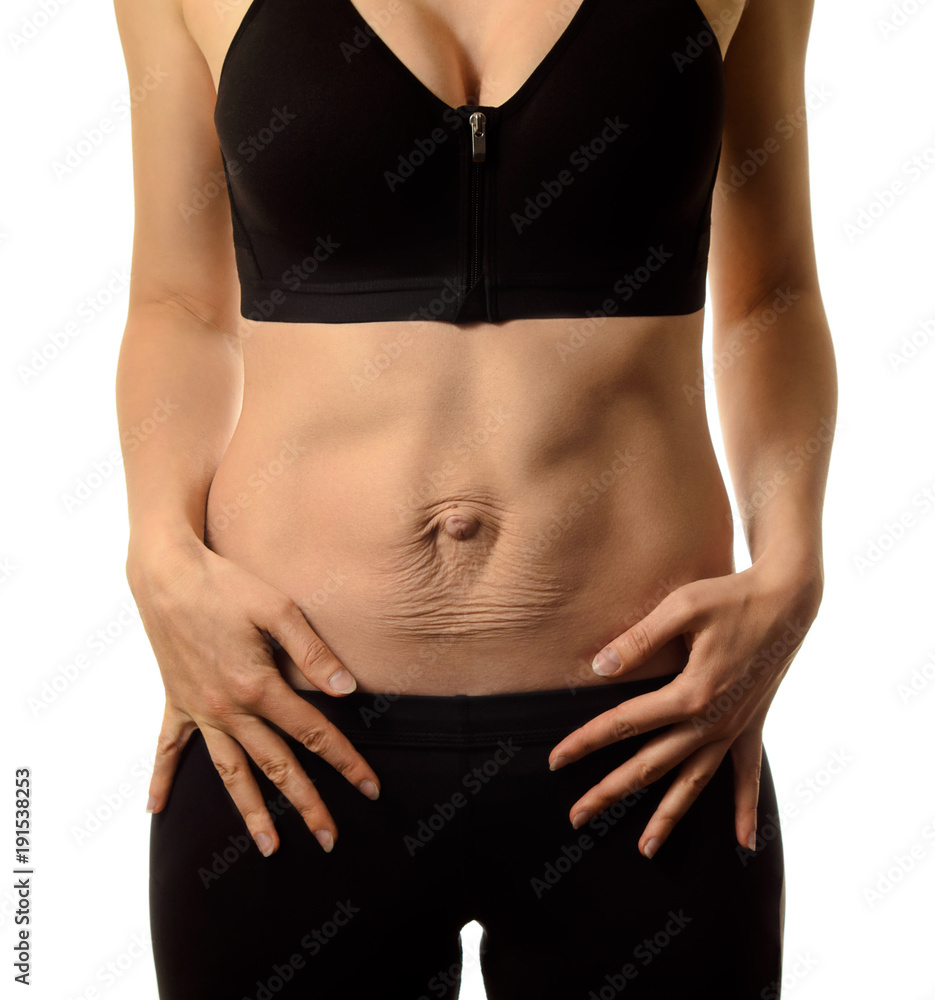 Diastasis recti. Woman's abdomen divergence of the muscles of the abdomen after pregnancy and childbirth.